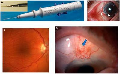 Complications of XEN gel stent implantation for the treatment of glaucoma: a systematic review